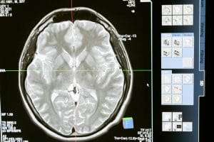 Picture showing symptom of magnesium deficiency