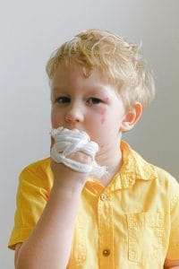 Picture showing a symptom of Vitamin K Deficiency