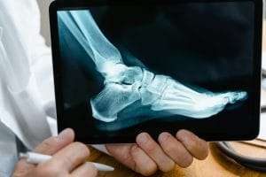 images for blog of bone health
